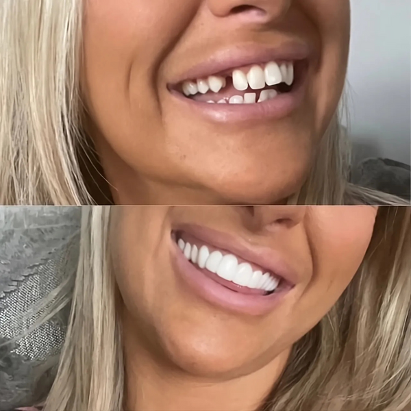 GadgetSpain™ - Carillas Dentales Instantáneas
